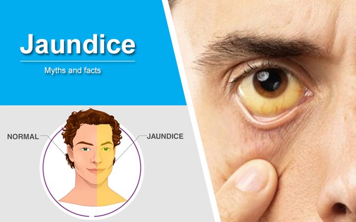 Jaundice-Myths-And-Facts