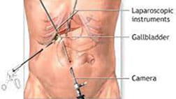 Gallbladder Surgery