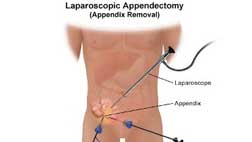 Lap Appendix Removal