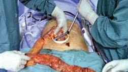 Lap Colorectal Incision