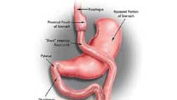 Lap Gastric Bypass Bariatric Surgery