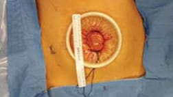 Laparoscopic Colon Surgery