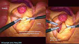 Laparoscopic Pancreas Surgery