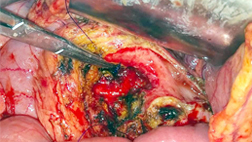 Opened Up Pancreas with Stone Removed