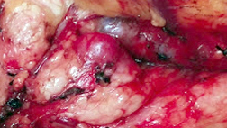 Pancreas Tumor