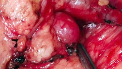 Pancreas Tumor