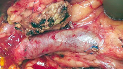 Remaining Pancreas After removal of Cancer