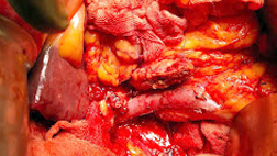 Remaining Pancreas After removal of Cancer