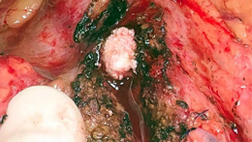 Stones in Pancreas Duct Stones in Pancreas Duct