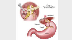 Fundoplication