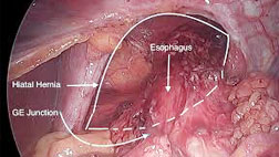 Lap Hiatus Hernia Repair