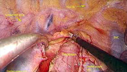 Laparoscopic Esophagectomy
