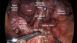 Laparoscopic Gastrectomy