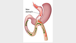 Mini Gastric Bypass