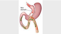 Minigastric Bypass
