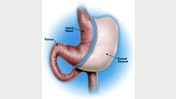 Sleeve Gastrectomy