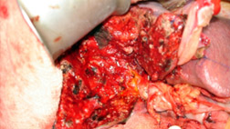 Liver-bed-after-resection-of-liver-tumor