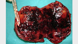 cut-section-of-resected-liver-tumor