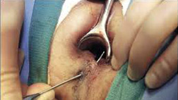 fistula-surgery