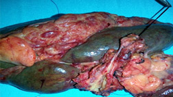 intrahepatic-duct-with-tumor