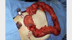 laparoscopic-colon-removal