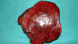 resected-liver-tumor
