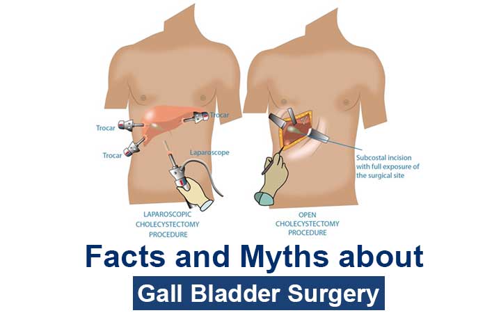 facts-about-gall-bladder-surgery